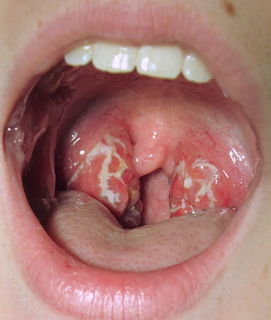 tonsil bengkak tonsillitis